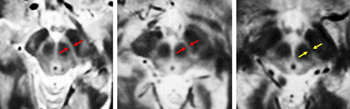 Image: MIT neuroscientists imaged the substantia nigra in a young adult, left, an older adult, center, and a Parkinson’s patient, right. They found that the substantia nigra deteriorates in Parkinson’s patients (Photo courtesy of David Ziegler).